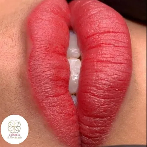 Resultado de tratamento estético na Clínica À Flor da Pele – resultado 1