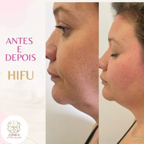 Resultado de tratamento estético na Clínica À Flor da Pele – resultado 10