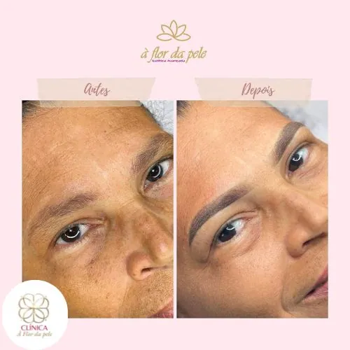 Resultado de tratamento estético na Clínica À Flor da Pele – resultado 11