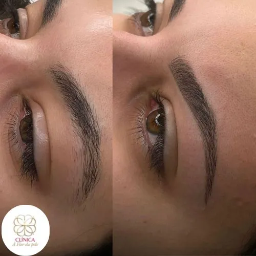 Resultado de tratamento estético na Clínica À Flor da Pele – resultado 13