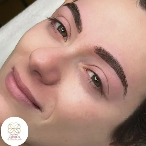 Resultado de tratamento estético na Clínica À Flor da Pele – resultado 14