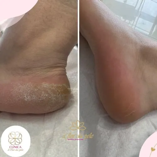 Resultado de tratamento estético na Clínica À Flor da Pele – resultado 16