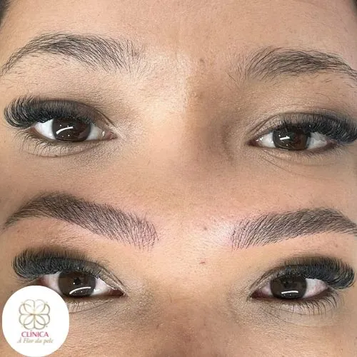 Resultado de tratamento estético na Clínica À Flor da Pele – resultado 17