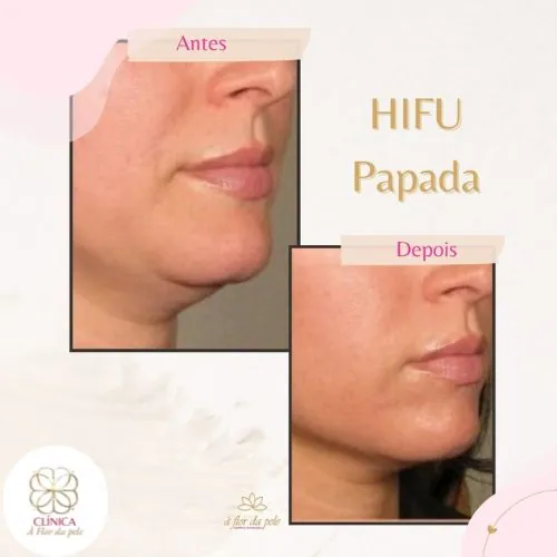 Resultado de tratamento estético na Clínica À Flor da Pele – resultado 19