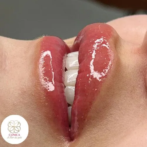 Resultado de tratamento estético na Clínica À Flor da Pele – resultado 2