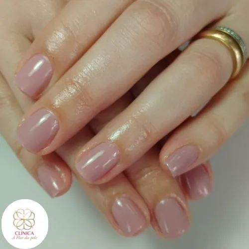 Resultado de tratamento estético na Clínica À Flor da Pele – resultado 20