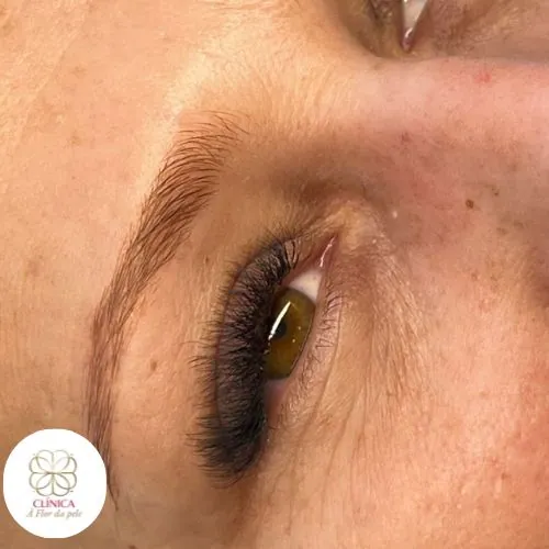 Resultado de tratamento estético na Clínica À Flor da Pele – resultado 4