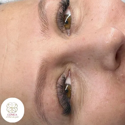 Resultado de tratamento estético na Clínica À Flor da Pele – resultado 5