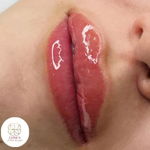 Resultado de tratamento estético na Clínica À Flor da Pele – resultado 7