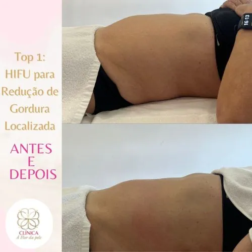 Resultado de tratamento estético na Clínica À Flor da Pele – resultado 9